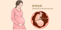 好孕36計 | 臍帶繞頸，我還能順產(chǎn)嗎